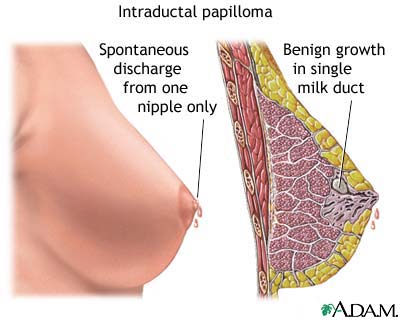 intraductal papilloma lumpectomy