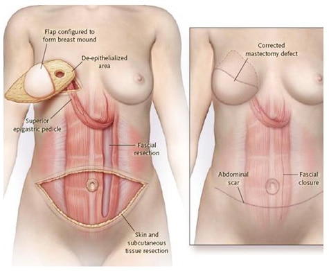 reconstruction diep lpg ricostruzione mastectomia nik mastectomy abdominal tummy infection oncologia